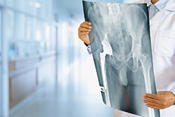 Benefits of Robotic Hip Replacement: Insights from Research and Data