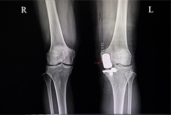 Partial vs. Total Knee Replacement: How Robotics Helps Make the Right Call