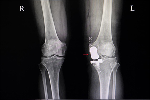 Partial vs. Total Knee Replacement: How Robotics Helps Make the Right Call